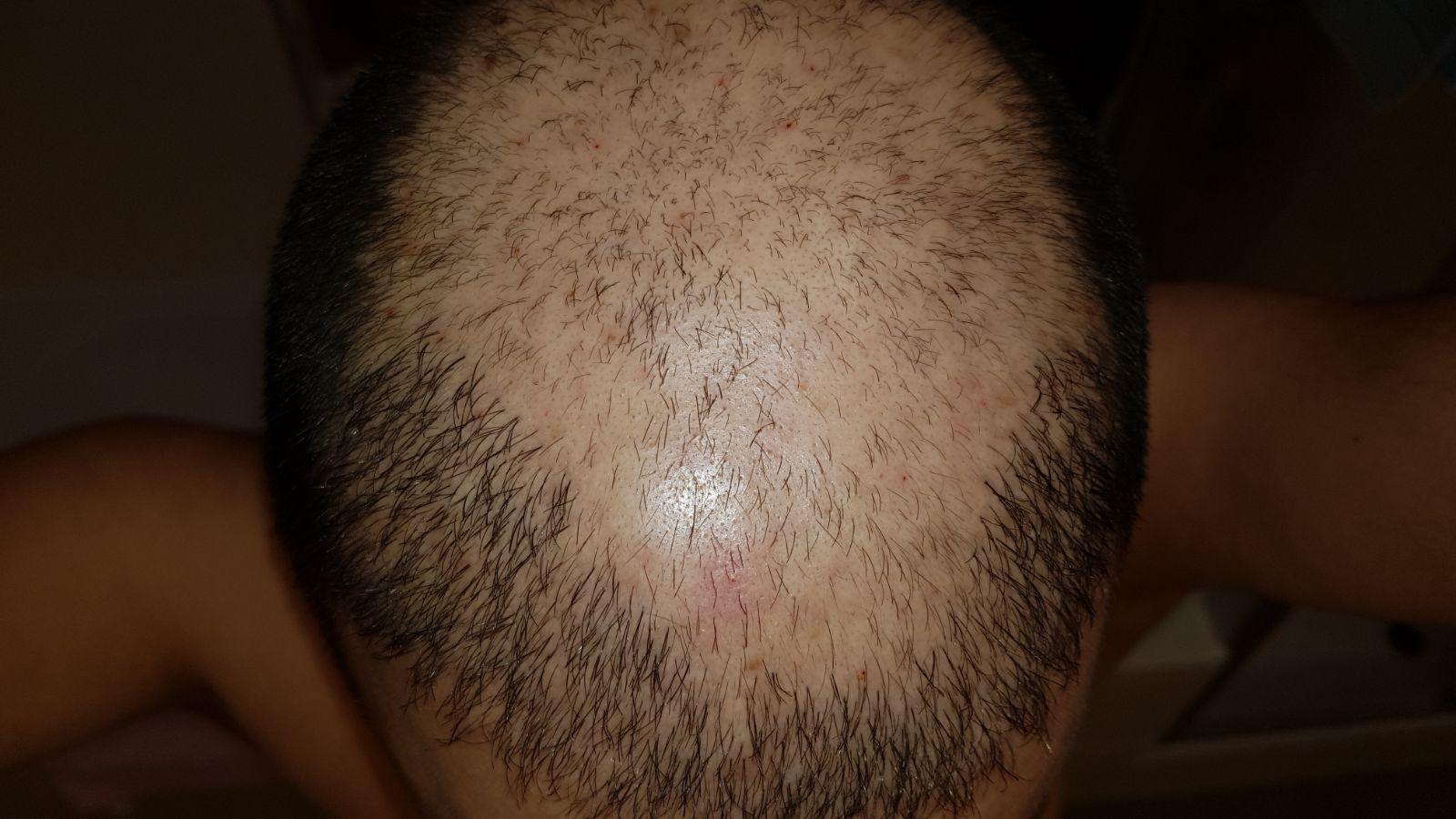 PRP Behandlung PRP Behandlung