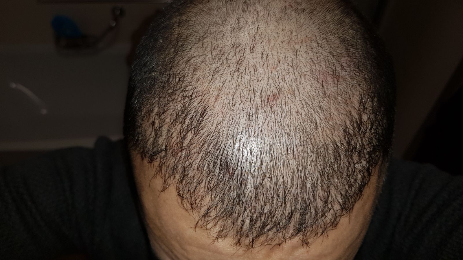 PRP Behandlung PRP Behandlung