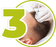 Injektion des Blutplasmas in die Kopfhaut bei einer PRP Behandlung