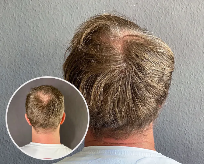 Vorher- und Nachher-Bild eines Patienten nach seiner PRP-Behandlung